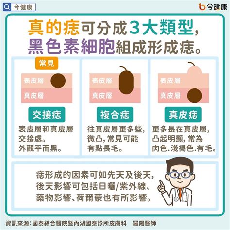 痣為什麼會凸起來|是痣or皮膚癌？醫「1張圖秒對照」 長這2部位最危險